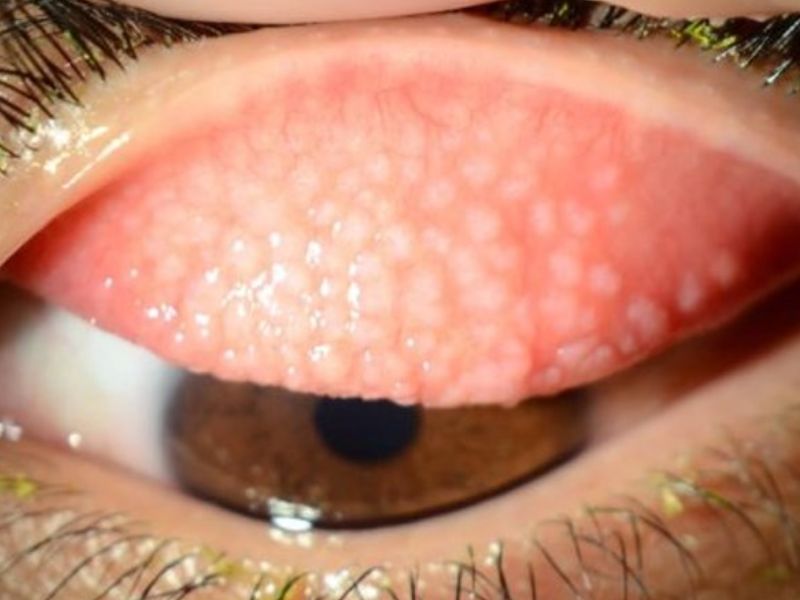 Bệnh đau mắt hột là bệnh nhiễm trùng mắt do vi khuẩn Chlamydia trachomatis gây ra