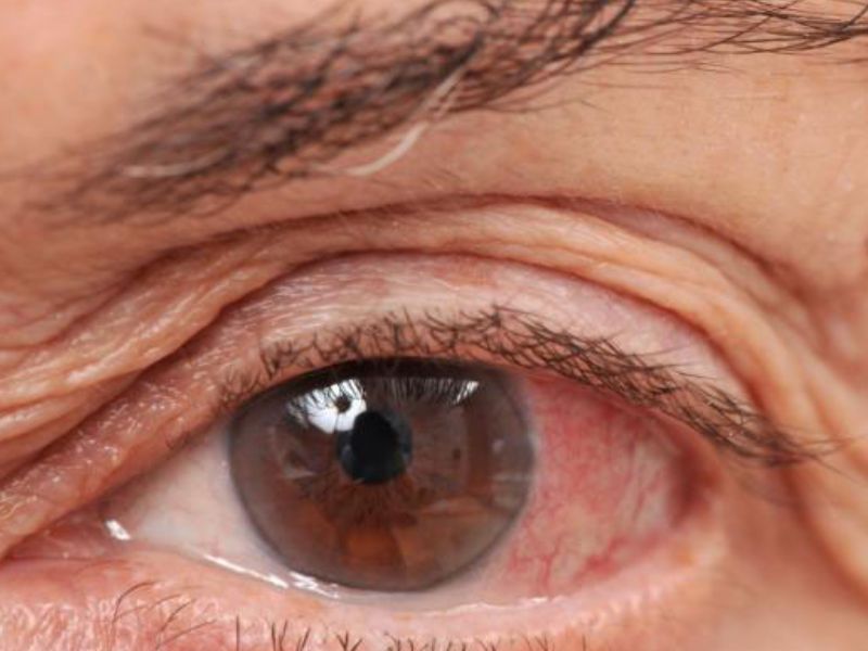 Bệnh Glaucoma là nhóm bệnh gây tổn thương thần kinh thị giác