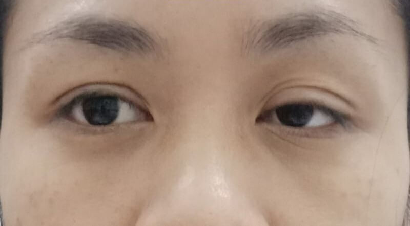 bệnh mắt to mắt nhỏ cách điều trị