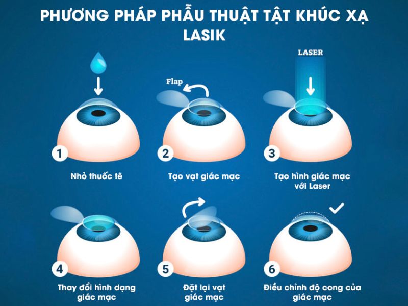 Các phương pháp mổ Lasik
