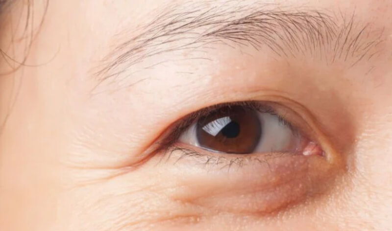 dấu hiệu bệnh tật khúc xạ mắt là gì