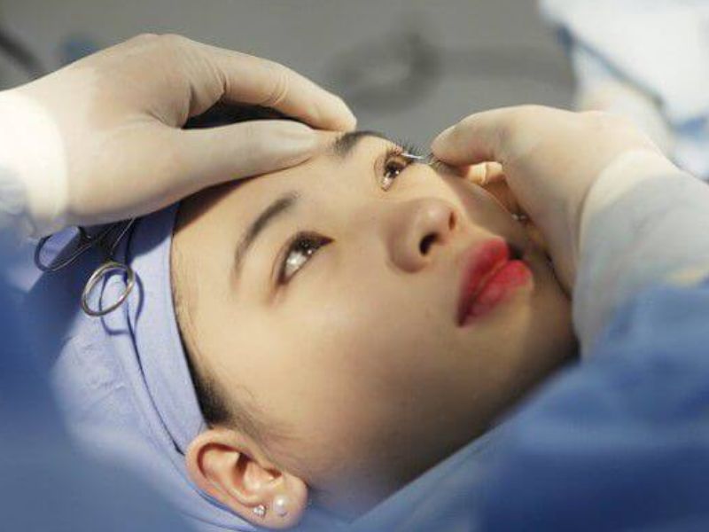 Chi phí mổ mắt Lasik