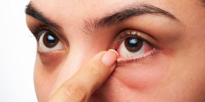 tư vấn bệnh ngứa mắt dùng thuốc gì