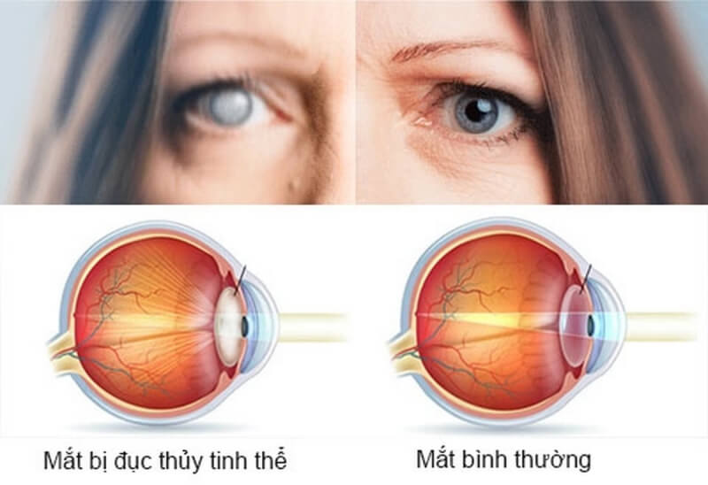 mờ mắt phải là bệnh gì? có nguy hiểm 