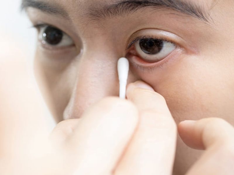Mắt nổi cộm có thể dùng tăm bông sạch để loại bỏ dị vật khỏi mắt