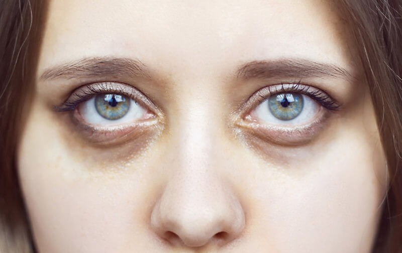 mắt thâm quầng là dấu hiệu bệnh gì