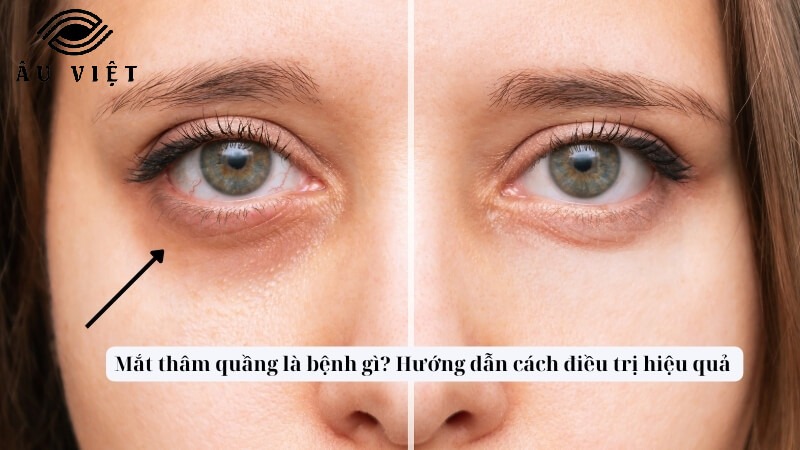 Mắt thâm quầng là bệnh gì? Hướng dẫn cách điều trị hiệu quả