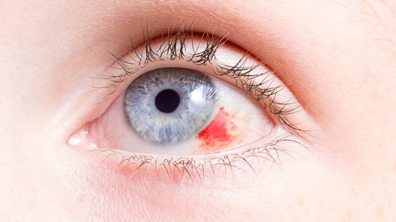mờ mắt là triệu chứng của bệnh gì
