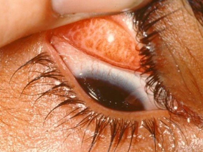 Nếu được điều trị đúng cách đau mắt hột nhẹ có thể khỏi sau 5 đến 6 tuần