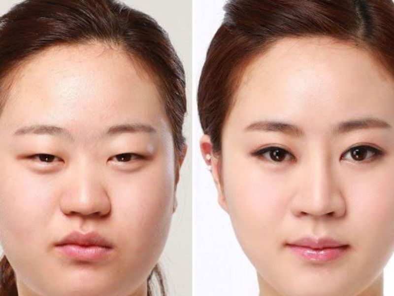 Phẫu thuật có làm mắt to tròn không