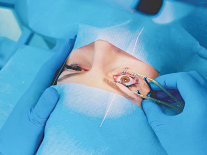 Phẫu thuật Lasik sử dụng tia laser Excimer để điều chỉnh độ cong giác mạc