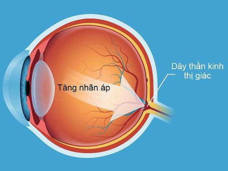 Sự tích tụ dịch thủy trong mắt do sản xuất quá mức là nguyên nhân tăng nhãn áp