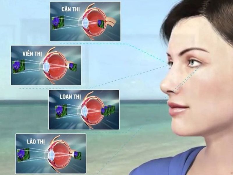 Tật khúc xạ là tình trạng ánh sáng không hội tụ đúng trên võng mạc