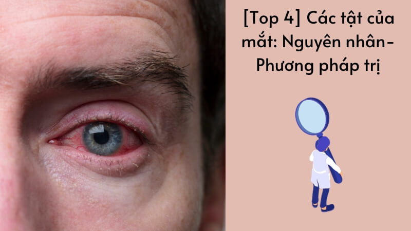 [Top 4] Các tật của mắt: Nguyên nhân- Phương pháp trị