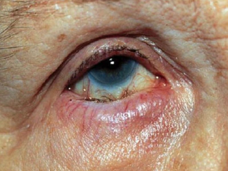 Triệu chứng đau mắt hột khiến bệnh nhân cảm thấy đau và mờ mắt
