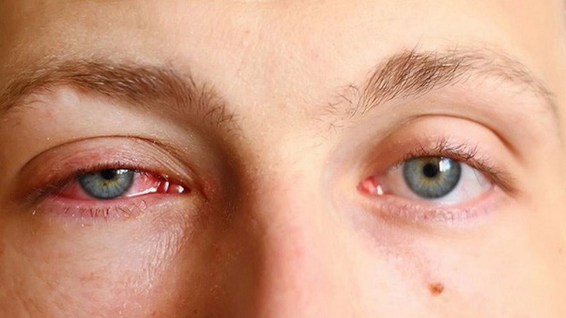 chuẩn đoán bệnh lao mắt